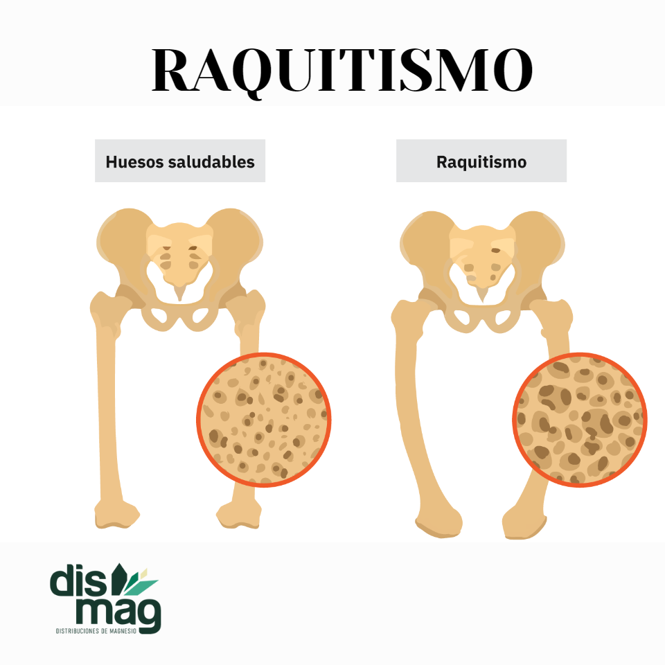 Foto Raquitismo